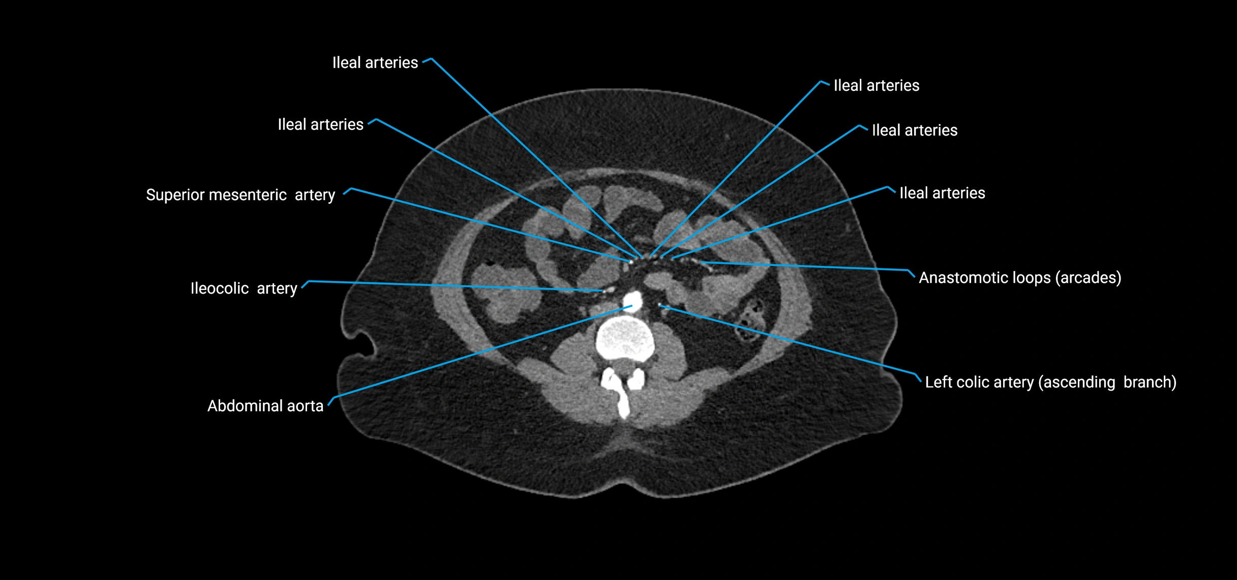 CTA abdomen axial cross sectional anatomy labelled image_109 (2).webp